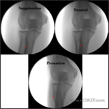 A/P Elbow Xray A/P Elbow Xray