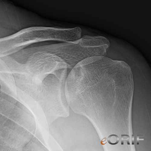 avascular necrosis humerus xray 