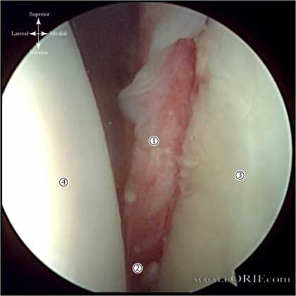 Bankart Lesion M24.419 718.31 Bankart lesions arthroscopic picture
