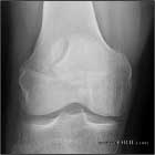 bipartitie patella AP