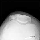 bipartitie patella 