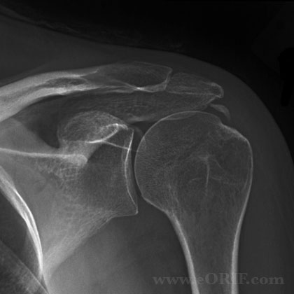 Rotator cuff calcification Xray Calcific tendinitis of the rotator cuff xray