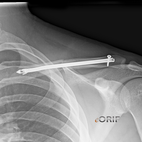 clavicle fracture sonoma nail