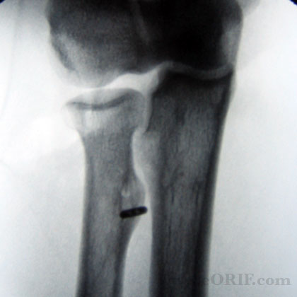distal biceps tendon repair xray distal biceps tendon repair xray