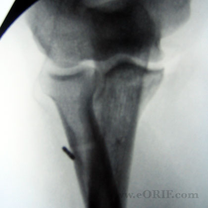 distal biceps tendon repair xray distal biceps tendon repair xray