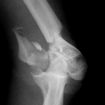 distal humerus fracture xray distal humerus fracture xray