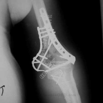 distal humerus fracture ORIF xray distal humerus fracture ORIF xray