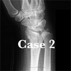 Distal radius fracture A/P xray