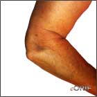 lateral elbow dislocation lateral elbow dislocation