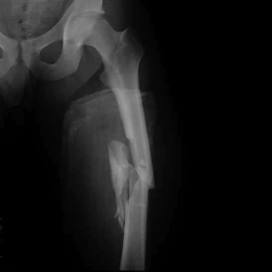 femoral shaft fracture x-ray Femoral shaft fracture xrray