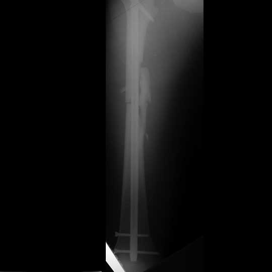 Femoral shaft fracture IM nail xray Femoral shaft fracture intrameduallary nail xray