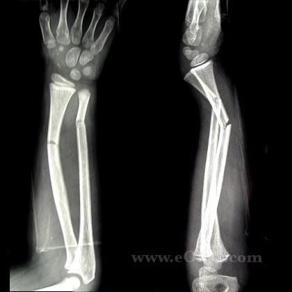 Pediatric forearm fracture xray