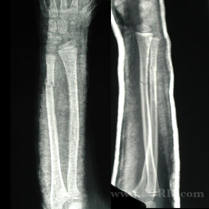Closed reduction pediatric forearm fracture xray