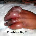 Frostbite Pic Frostbite image