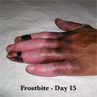 Frostbite healing pic Frostbite healing image