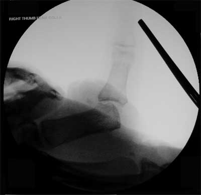 Gamekeeper's Skier's thumb xray