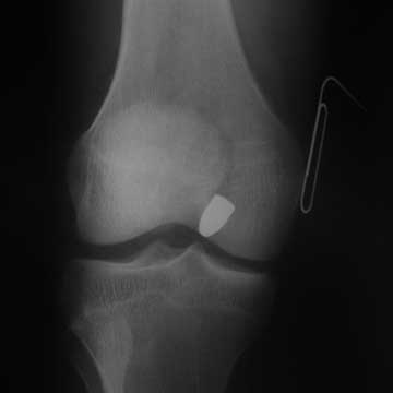 Knee GSW image