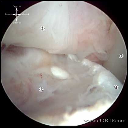 Hill-Sachs Lesion Hill-Sachs Lesion arthroscopic picture