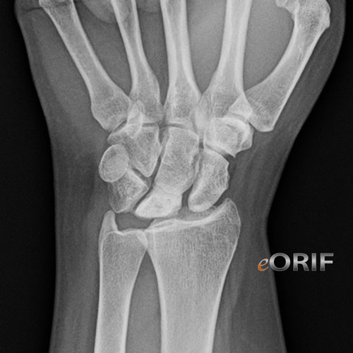Keinbock's Disease xray Keinbock's Disease xray