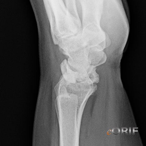 Keinbock's Disease xray Keinbock's Disease xray