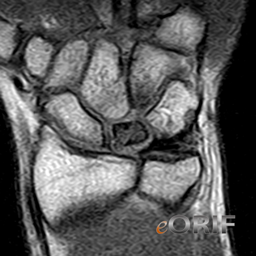 lunate avn mri lunate avn mri