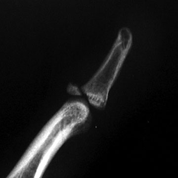Mallet finger xray Mallet Finger xray