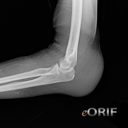 olecranon bursitis xray olecranon bursitis xray