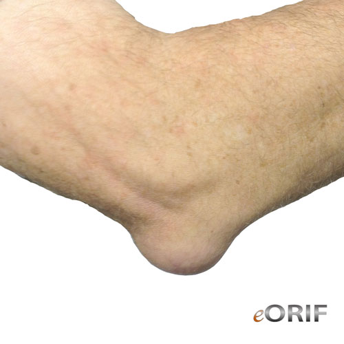 olecranon bursitis olecranon bursitis