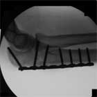 olecranon fracture ORIF xray olecranon fracture ORIF xray