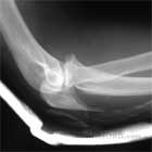 olecranon fracture xray Olecranon Fracture xray
