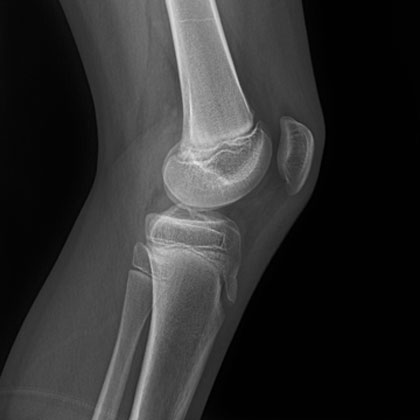 Osgood-Schlatter Disease xray Osgood-Schlatter Disease xray