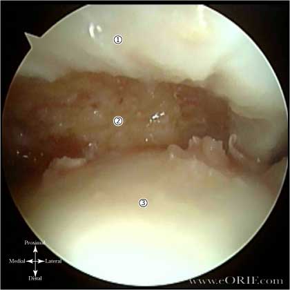 patellar dislocation picture