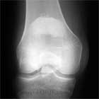 Patella fracture xray Displaced patella fracture A/P view