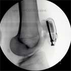 ORIF patella fracture xray ORIF patella fracture lateral view xray