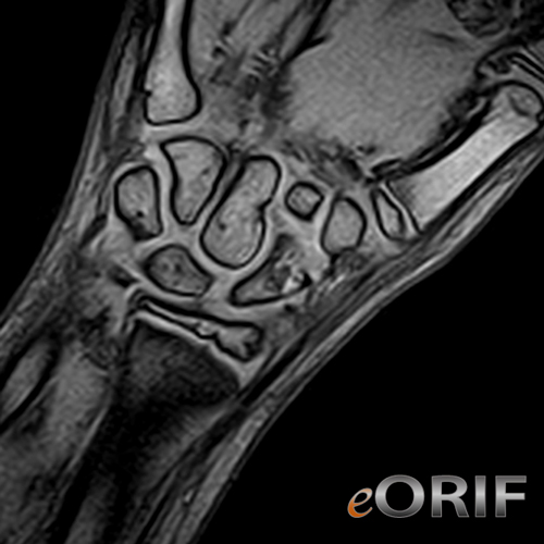 Pediatric Scaphoid Fracture mri pediatric scaphoid fracture mri