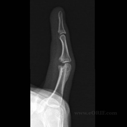 Phalangeal neck malunion Phalangeal neck fracture malunion xray