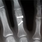Proximal phalanx ORIF xray