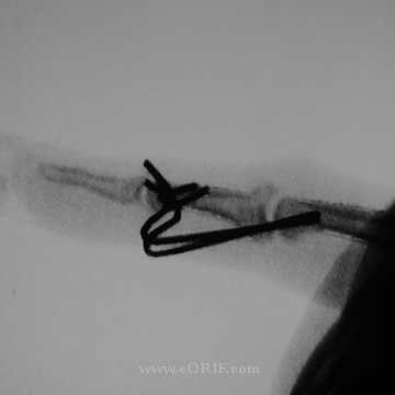 PIP external fixation xray