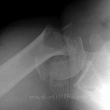 Proximal Humerus Fracture xray