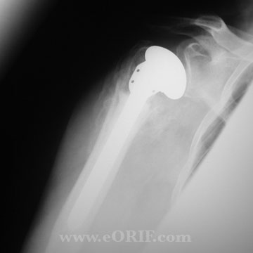 Proximal humerus hemiarthroplasty Proximal humerus hemiarthoplasty xray