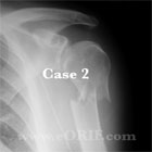 Proximal humerus fracture xray Proximal humerus fracture xray