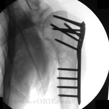 Proximal humerus ORIF xray Proximal humerus ORIF xray