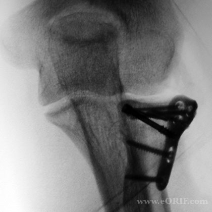 Radial Head Fracture ORIF 24665 Radial Head Fracture ORIF xray