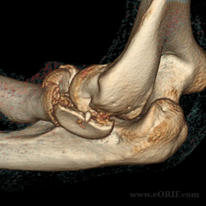 Radial head fracture 3d CT scan