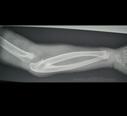 Radioulnar synostosis xray