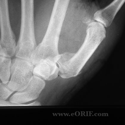 Rolando's Fracture xray Rolando's Fracture xray