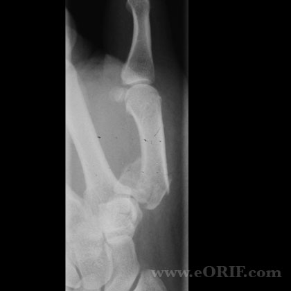 Rolando's fracture Rolando's Fracture lateral xray