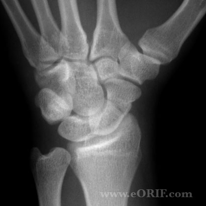 Scaphoid fracture xray Acute scaphoid fracture xray