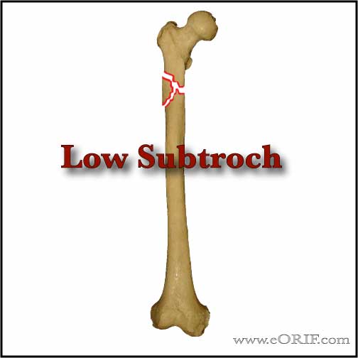 low subtract femur fracture picture low subtract femur fracture picture