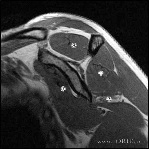 Teres atrophy Teres atrophy MRI